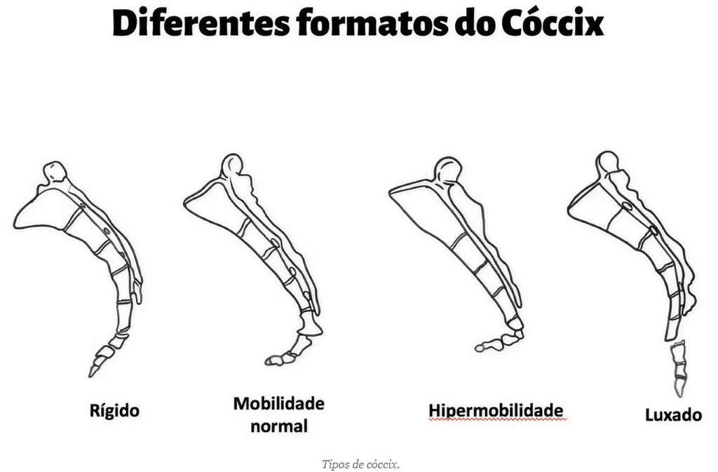 Anatomia da fratura do cóccix, tempo de recuperação e cobertura pelo INSS