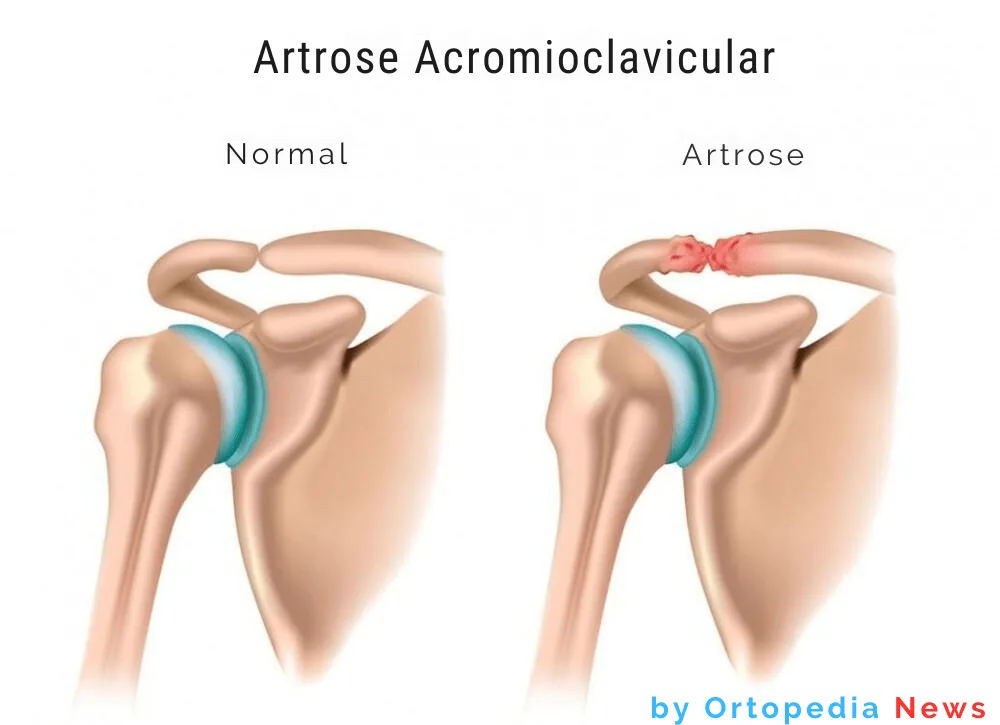 Artrose Acromioclavicular Causas e Tratamento