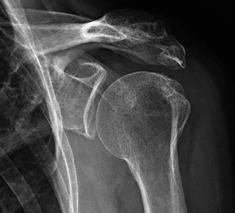 Imagem de uma Artrose Acromioclavicular após fratura