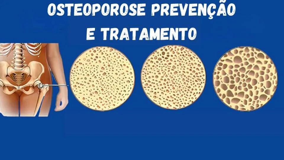 Osteoporose Prevenção e Tratamento