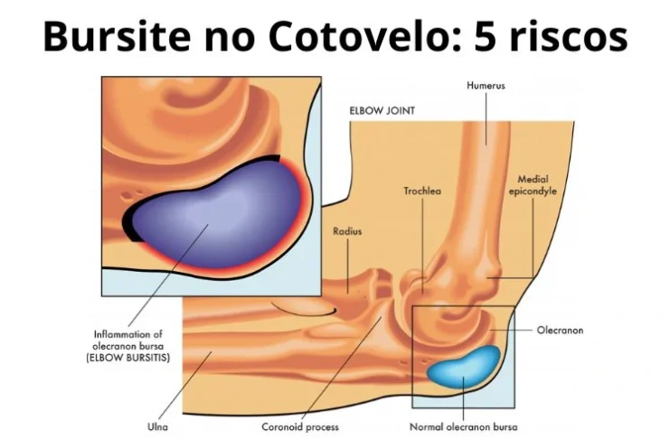 Bursite no cotovelo tratamento
