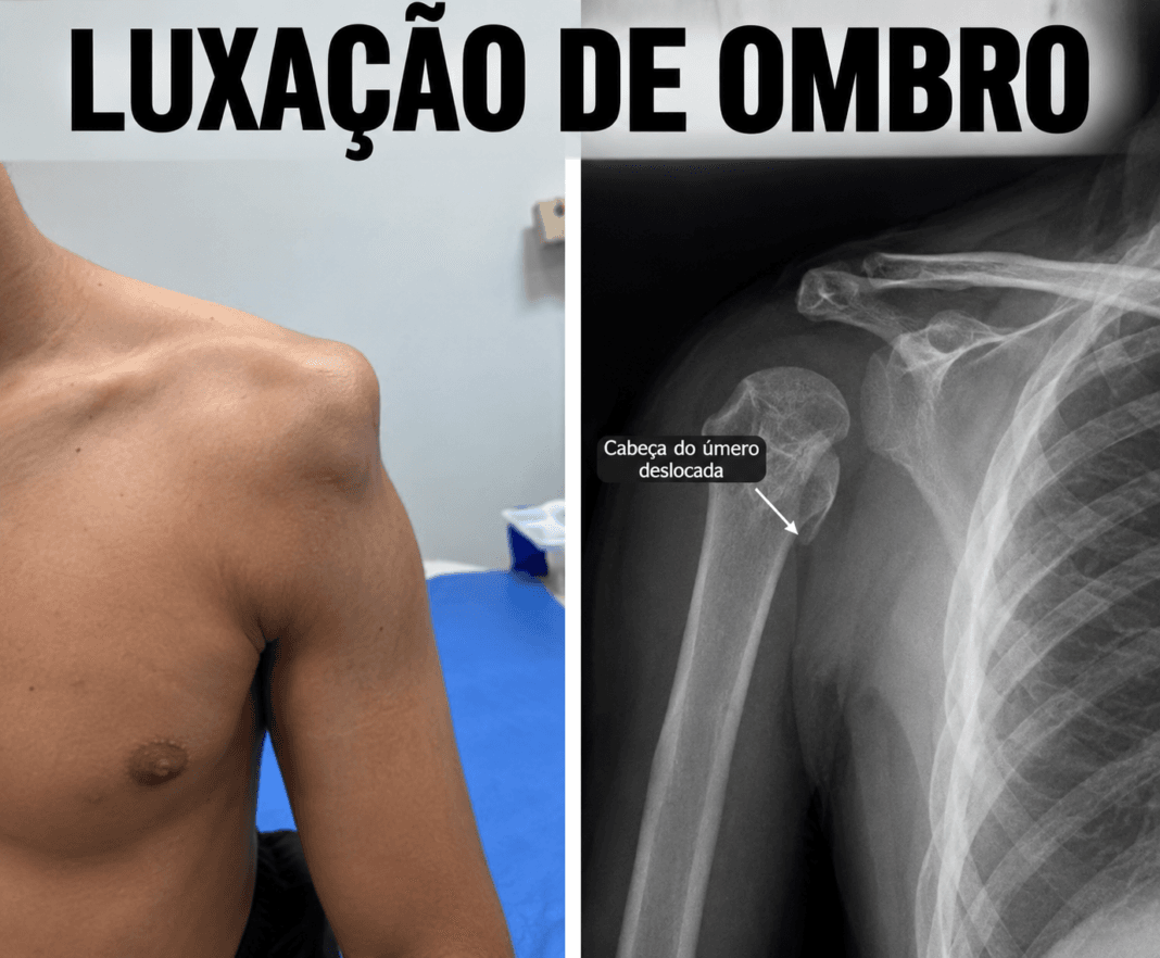 luxação de ombro causas , tratamento e cirurgia