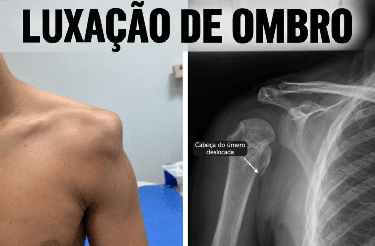 luxação de ombro causas , tratamento e cirurgia